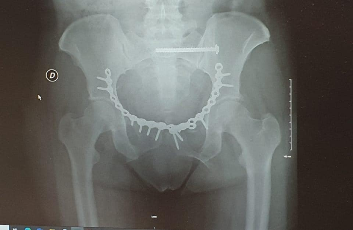A little humor I finally got my motorcycle chain back the surgeon put it on my pelvis