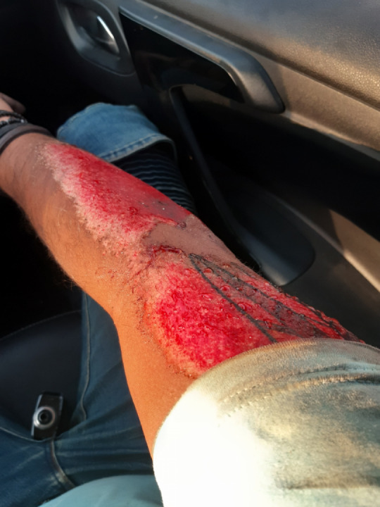 RECAP: Two months ago (sorry for the injury image)