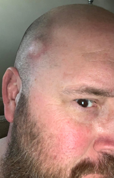 Yellowjacket in the noggin bucket…